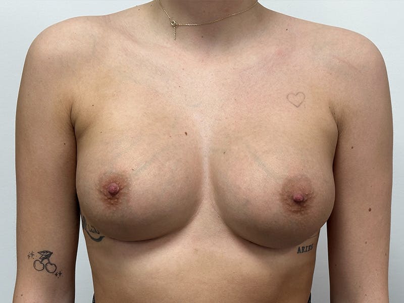 Breast Augmentation Before & After Gallery - Patient 148337617 - Image 2