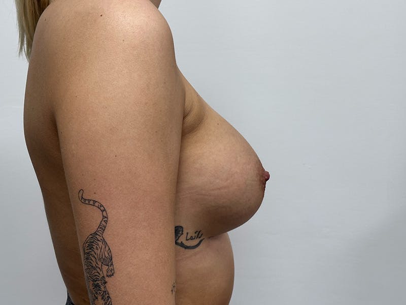 Breast Augmentation Before & After Gallery - Patient 148337617 - Image 6