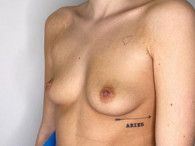 Breast Augmentation Before & After Gallery - Patient 148337617 - Image 7
