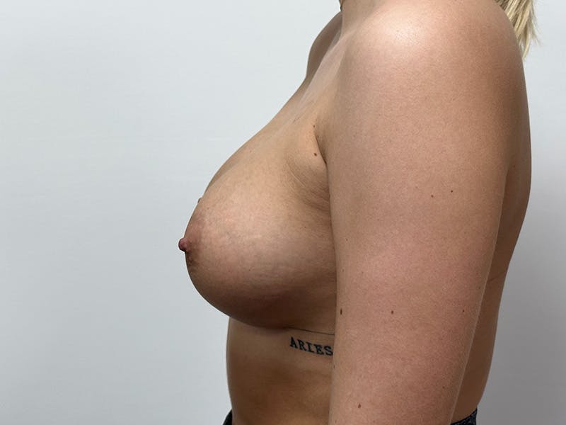 Breast Augmentation Before & After Gallery - Patient 148337617 - Image 10