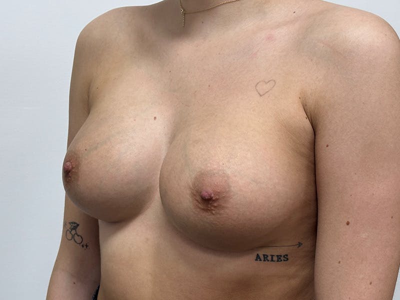 Breast Augmentation Before & After Gallery - Patient 148337617 - Image 8