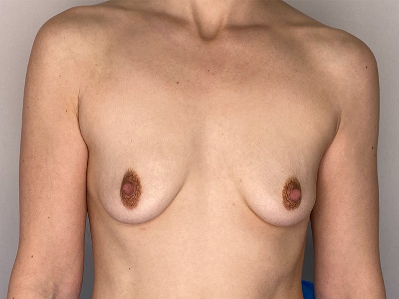 Breast Augmentation Before & After Gallery - Patient 148337616 - Image 1
