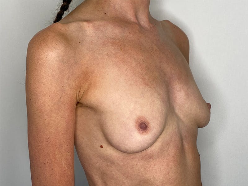 Breast Augmentation Before & After Gallery - Patient 148337618 - Image 1