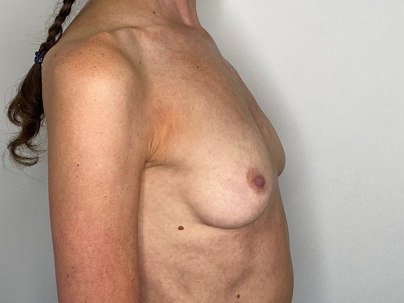 Breast Augmentation Before & After Gallery - Patient 148337618 - Image 3