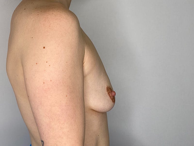 Breast Augmentation Before & After Gallery - Patient 148337616 - Image 5