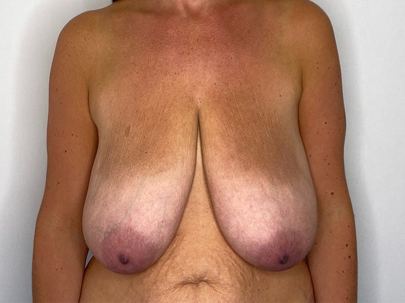 Breast Reduction  Before & After Gallery - Patient 148337620 - Image 1