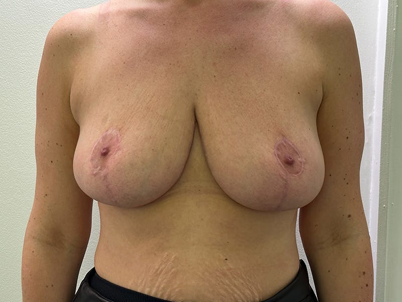 Breast Reduction  Before & After Gallery - Patient 148337620 - Image 2