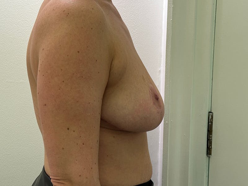 Breast Reduction  Before & After Gallery - Patient 148337620 - Image 6