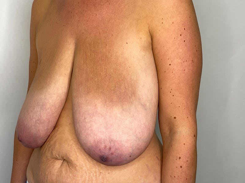 Breast Reduction  Before & After Gallery - Patient 148337620 - Image 7