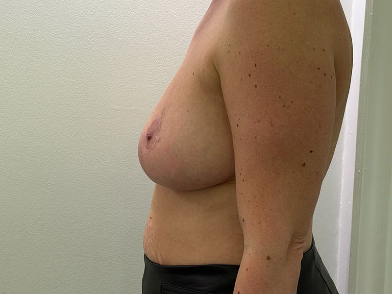 Breast Reduction  Before & After Gallery - Patient 148337620 - Image 10
