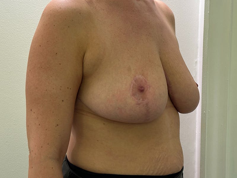 Breast Reduction  Before & After Gallery - Patient 148337620 - Image 4