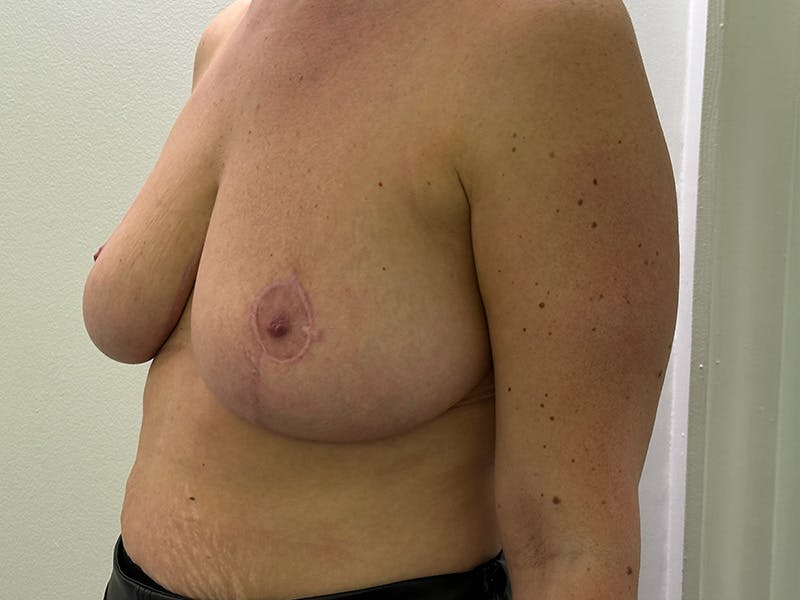 Breast Reduction  Before & After Gallery - Patient 148337620 - Image 8
