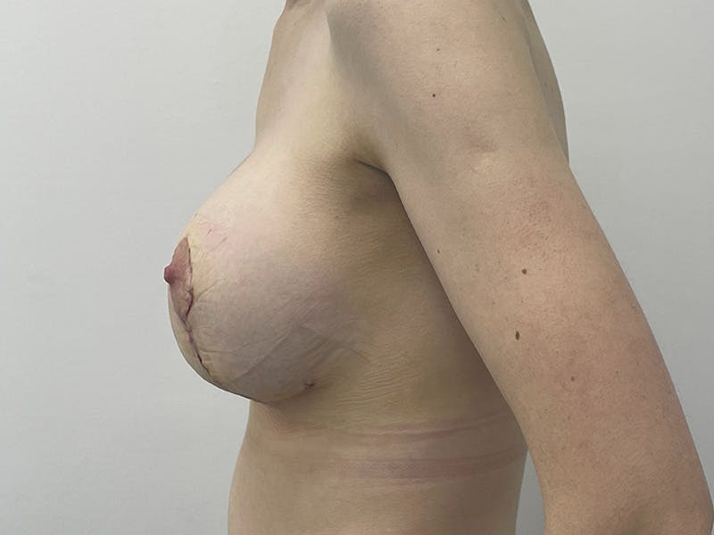 Breast Uplift with Implants Before & After Gallery - Patient 148337622 - Image 4