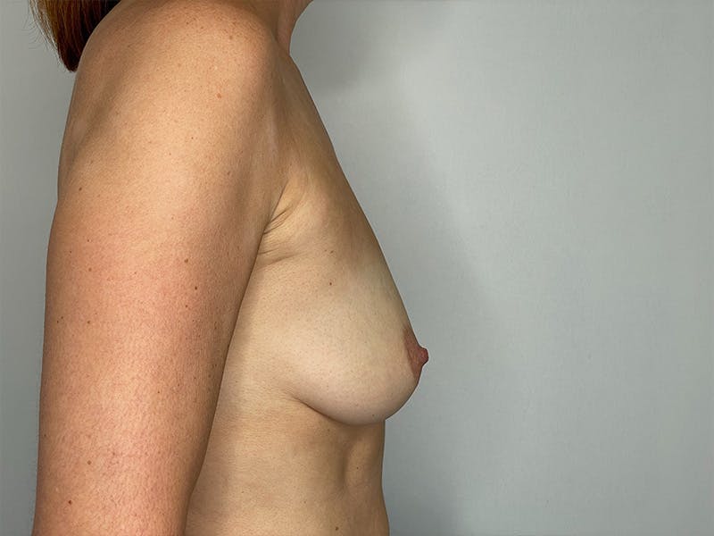 Breast Uplift with Implants Before & After Gallery - Patient 148337621 - Image 5