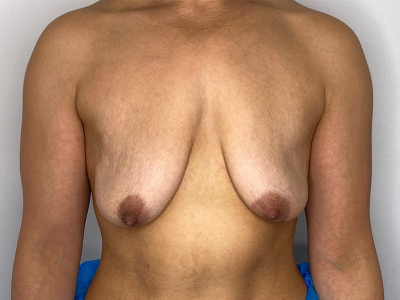 Breast Uplift with Implants Before & After Gallery - Patient 148337623 - Image 1