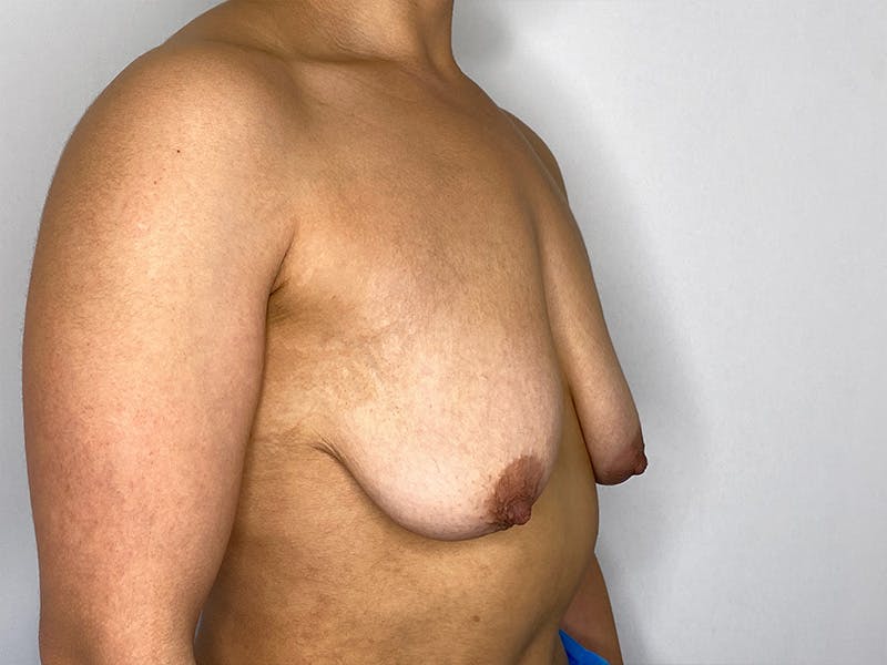 Breast Uplift with Implants Before & After Gallery - Patient 148337623 - Image 3