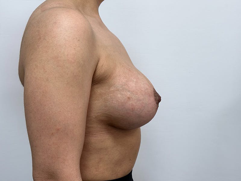 Breast Uplift with Implants Before & After Gallery - Patient 148337623 - Image 6