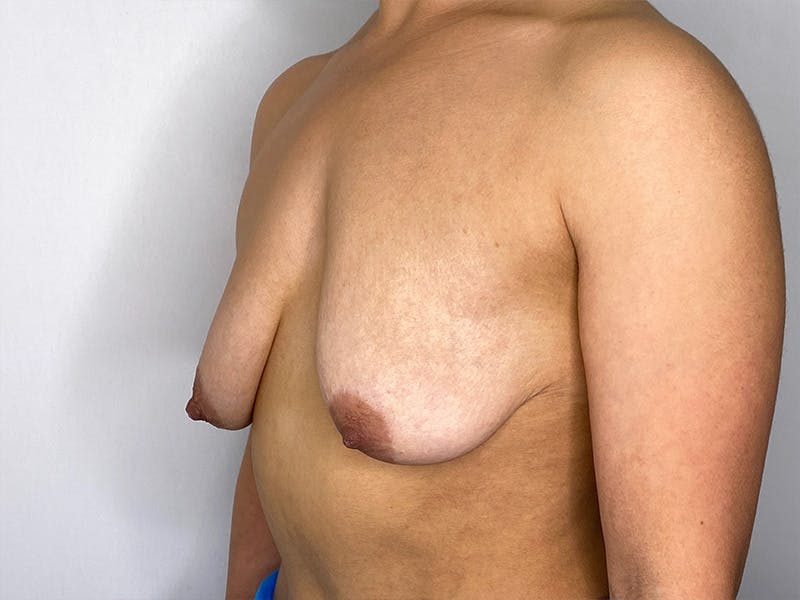 Breast Uplift with Implants Before & After Gallery - Patient 148337623 - Image 7
