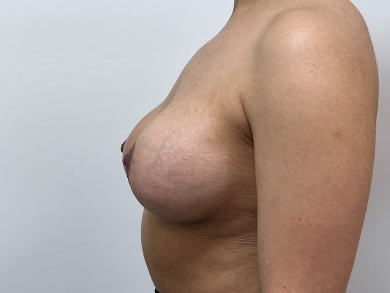 Breast Uplift with Implants Before & After Gallery - Patient 148337623 - Image 10