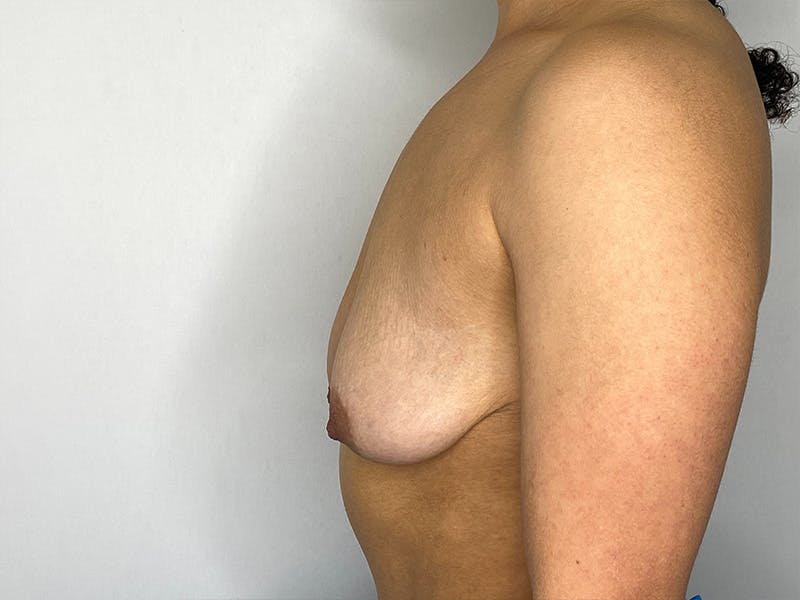 Breast Uplift with Implants Before & After Gallery - Patient 148337623 - Image 9
