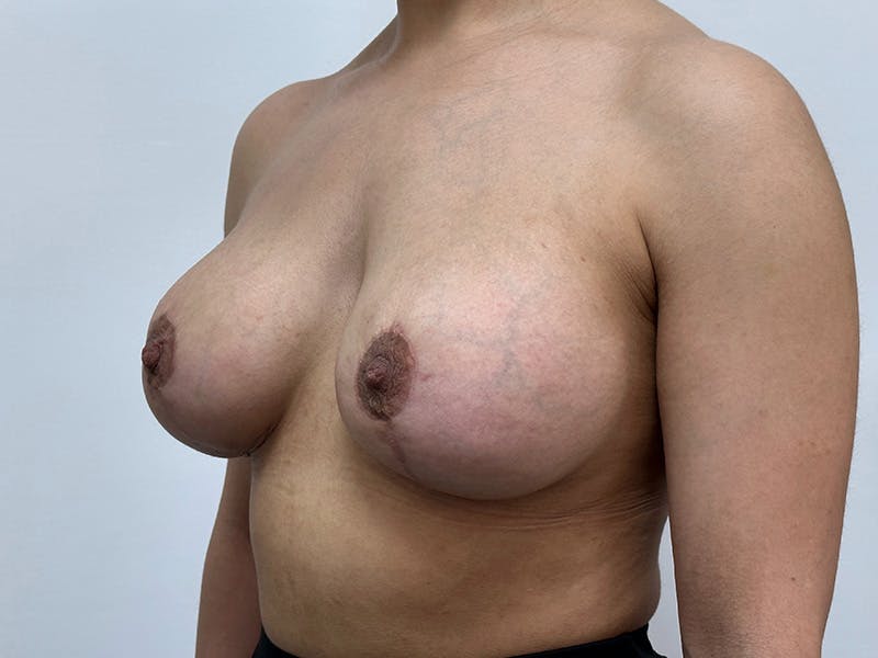 Breast Uplift with Implants Before & After Gallery - Patient 148337623 - Image 8