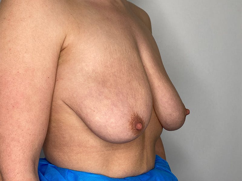 Breast Uplift with Implants Before & After Gallery - Patient 148337629 - Image 3
