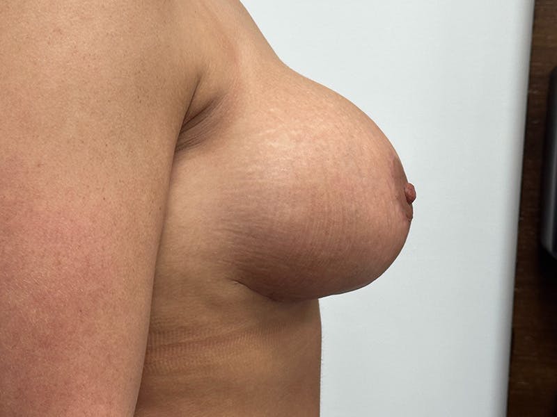 Breast Uplift with Implants Before & After Gallery - Patient 148337629 - Image 6
