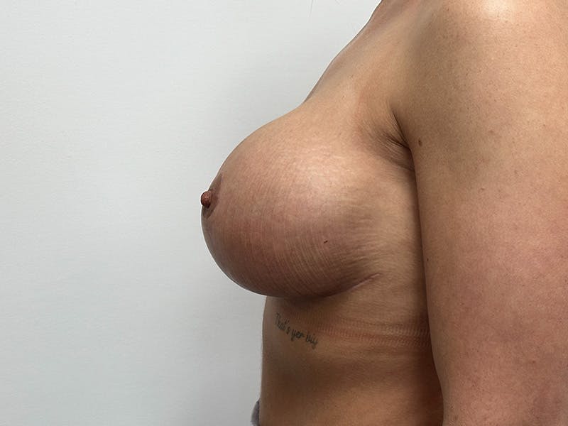 Breast Uplift with Implants Before & After Gallery - Patient 148337629 - Image 10