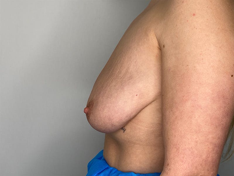 Breast Uplift with Implants Before & After Gallery - Patient 148337629 - Image 9