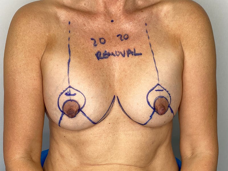 Exchange of Breast Implants Before & After Gallery - Patient 148337646 - Image 1