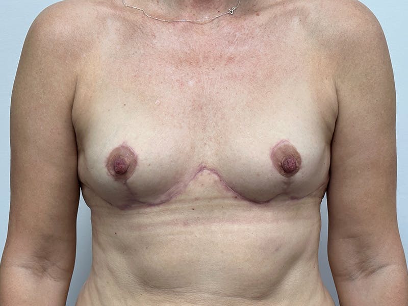 Exchange of Breast Implants Before & After Gallery - Patient 148337646 - Image 2