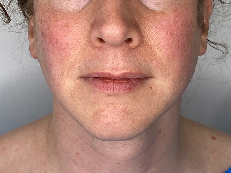 Lip Lift Before & After Gallery - Patient 148337647 - Image 1