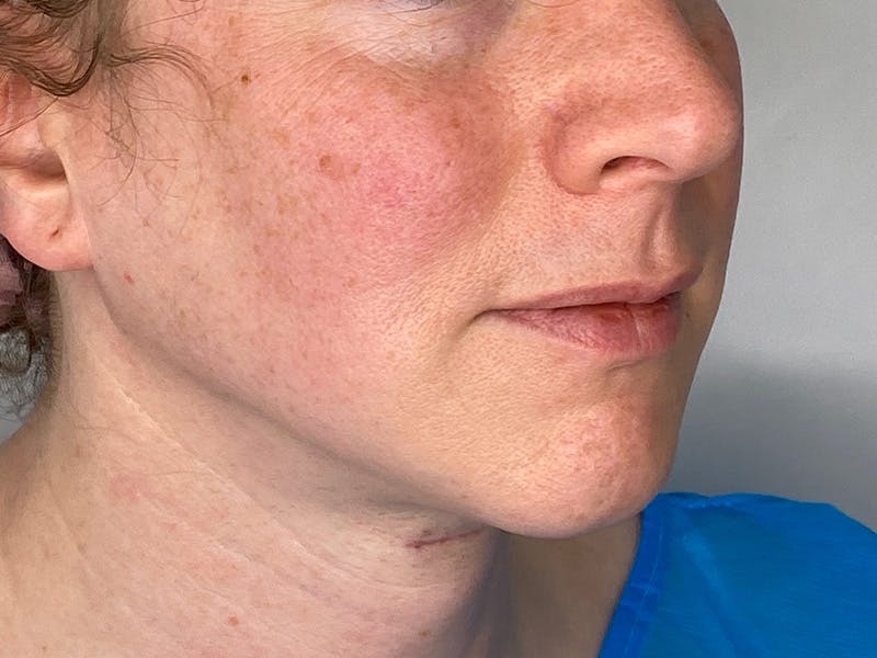 Lip Lift Before & After Gallery - Patient 148337647 - Image 3