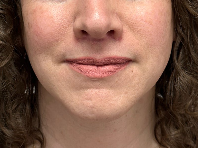 Lip Lift Before & After Gallery - Patient 148337647 - Image 2