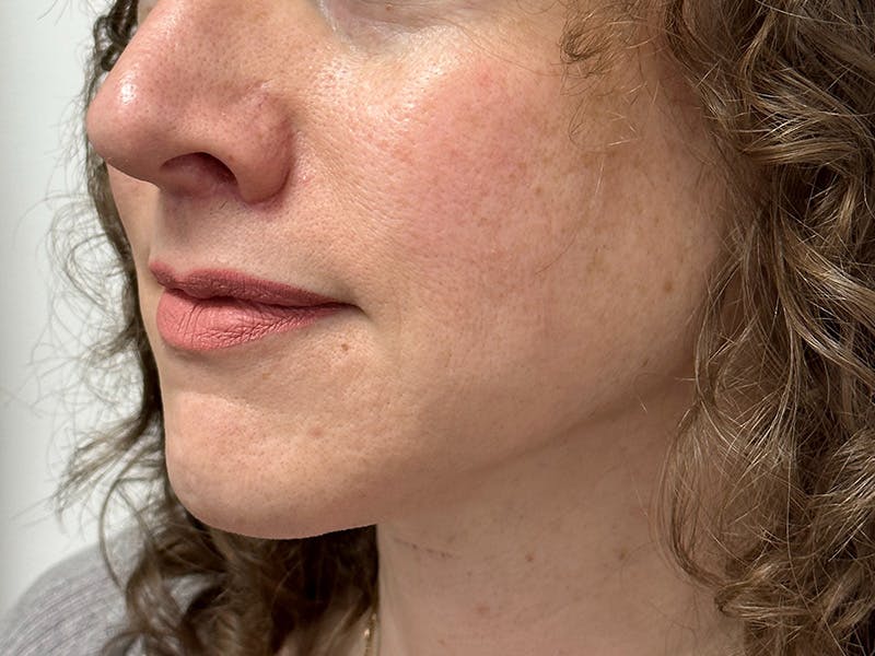 Lip Lift Before & After Gallery - Patient 148337647 - Image 6
