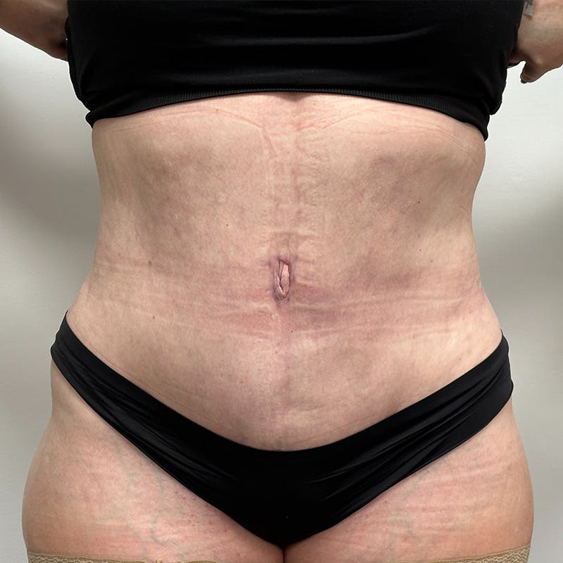 Mummy Makeover Before & After Gallery - Patient 148337654 - Image 2