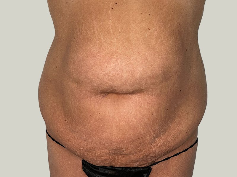Tummy Tuck Before & After Gallery - Patient 148337657 - Image 1