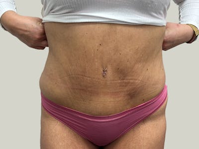 Tummy Tuck Before & After Gallery - Patient 148337657 - Image 2
