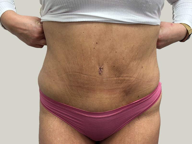Tummy Tuck Before & After Gallery - Patient 148337657 - Image 2