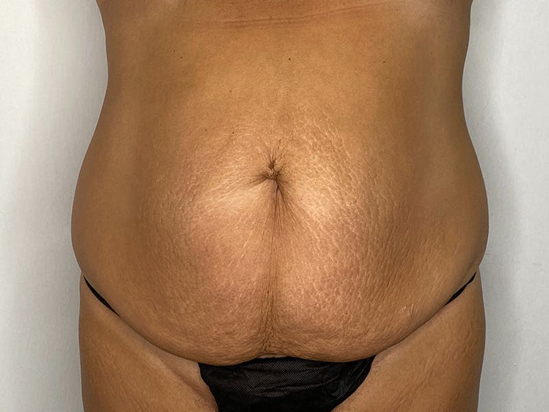 Tummy Tuck Before & After Gallery - Patient 148337656 - Image 1