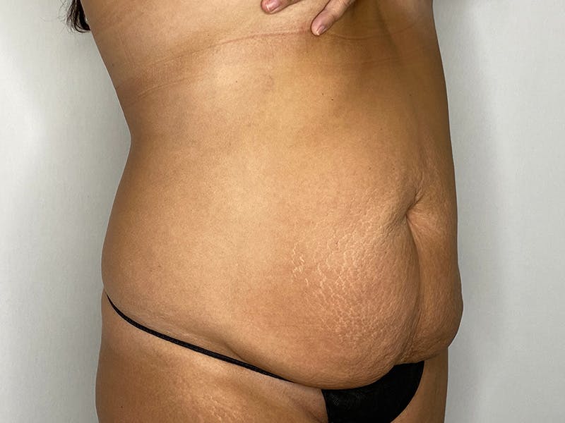 Tummy Tuck Before & After Gallery - Patient 148337656 - Image 3