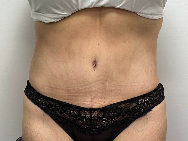 procedure patient
