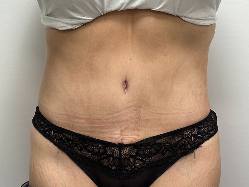 Tummy Tuck Before & After Gallery - Patient 148337656 - Image 2