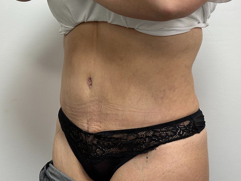 Tummy Tuck Before & After Gallery - Patient 148337656 - Image 6