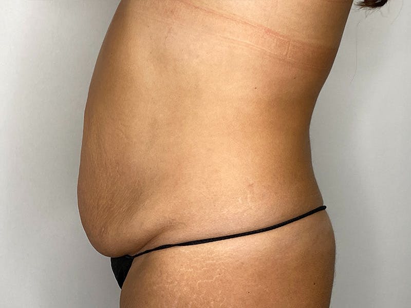 Tummy Tuck Before & After Gallery - Patient 148337656 - Image 7