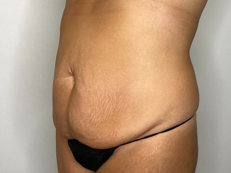 Tummy Tuck Before & After Gallery - Patient 148337656 - Image 5