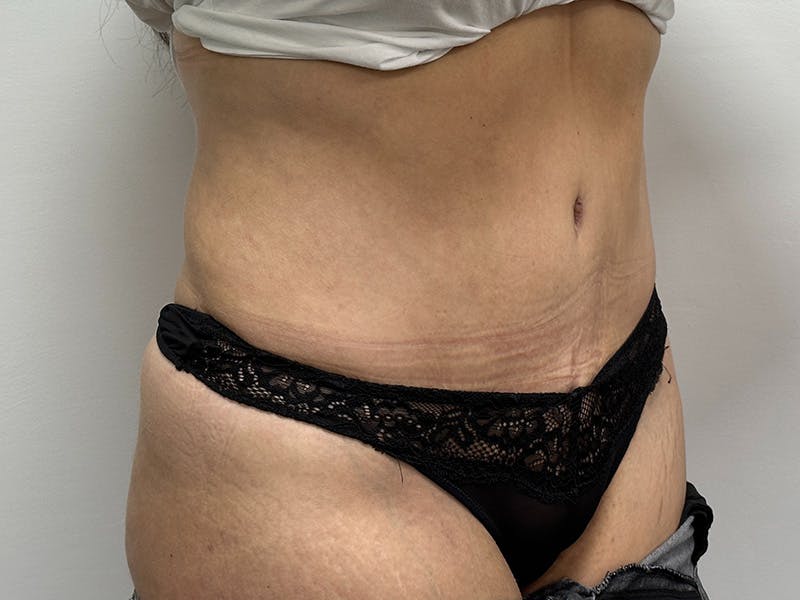 Tummy Tuck Before & After Gallery - Patient 148337656 - Image 4