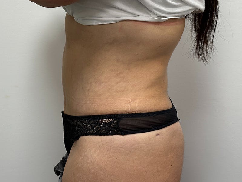 Tummy Tuck Before & After Gallery - Patient 148337656 - Image 8