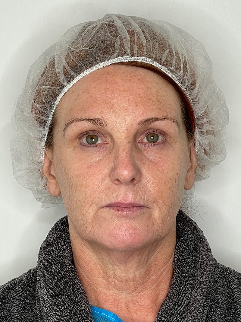 Facelift Before & After Gallery - Patient 149050082 - Image 1