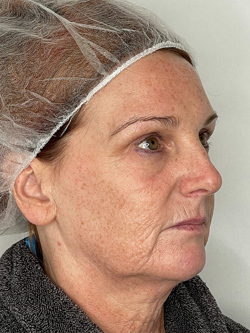 Facelift Before & After Gallery - Patient 149050082 - Image 3